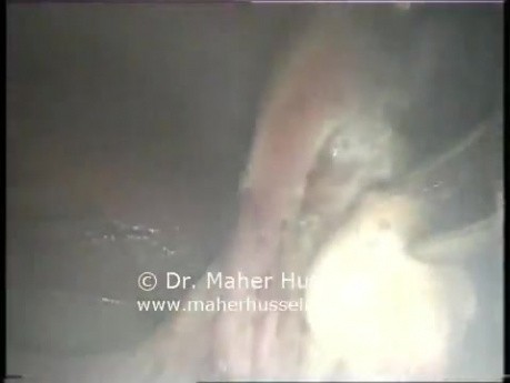 Transumbilical Appendectomy - Laparoscopy