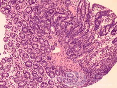 Duodenal Mucosa in Celiac Disease (6 of 6)