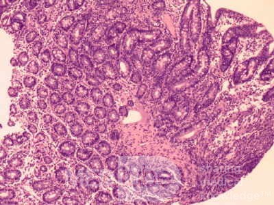 Duodenal Mucosa in Celiac Disease (6 of 6)