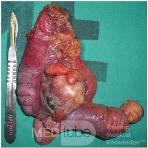 Caecal Tumor