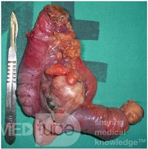 Caecal Tumor