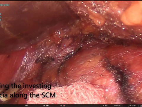 Retro-auricular (Facelift incision) approach to thyroidectomy