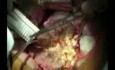 Abdominal Aortic Aneurysm
