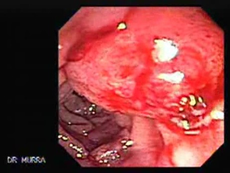 Adenocarcinoma of Papilla of Vater (3 of 5)