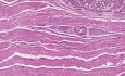 Squamous cell carcinoma - Histopathology - Esophagus, liver