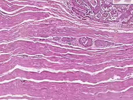 Squamous cell carcinoma - Histopathology - Esophagus, liver