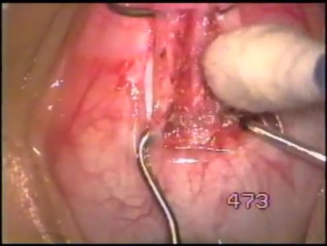 Inferior Rectus Muscle - Recession / Weakening