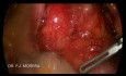 Retroperitoneal Teratoma