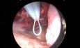 Microhysteroscopy. Double Uterus. Resection of Uterine Polyps