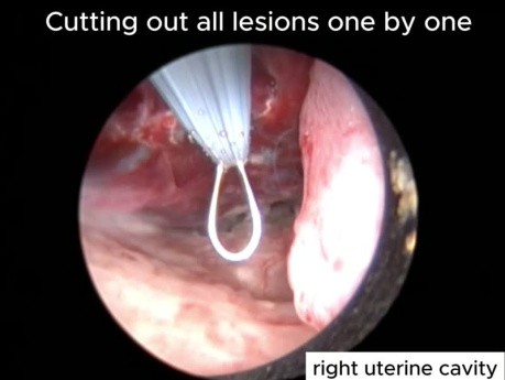Microhysteroscopy. Double Uterus. Resection of Uterine Polyps