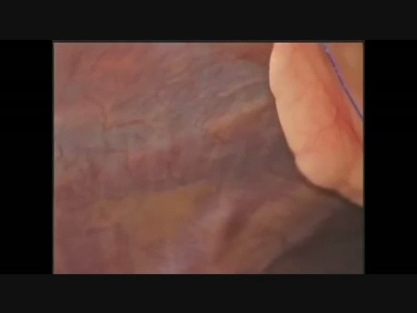 Laparoscopic Recurrent Umbilical Hernia Repair