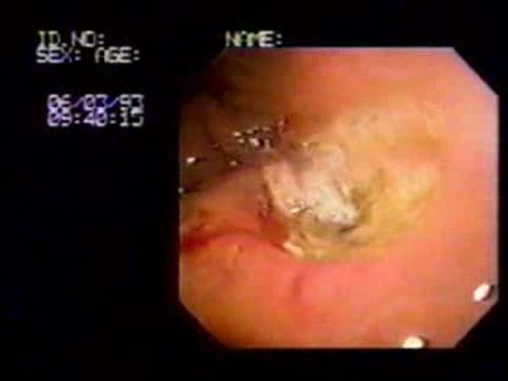 Large Gastric Ulcer (1 of 2)