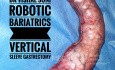 Robotic Vertical Sleeve Gastrectomy