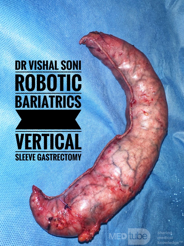 Robotic Vertical Sleeve Gastrectomy