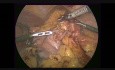 Laparoscopic Radical D2 Subtotal Gastrectomy