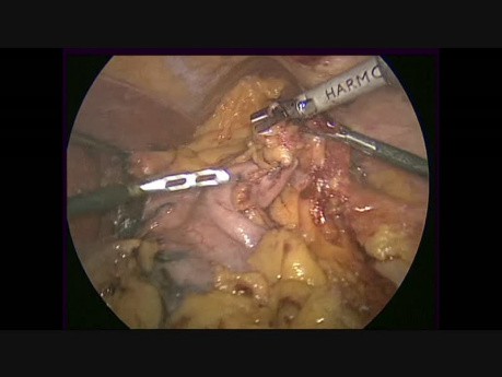 Laparoscopic Radical D2 Subtotal Gastrectomy