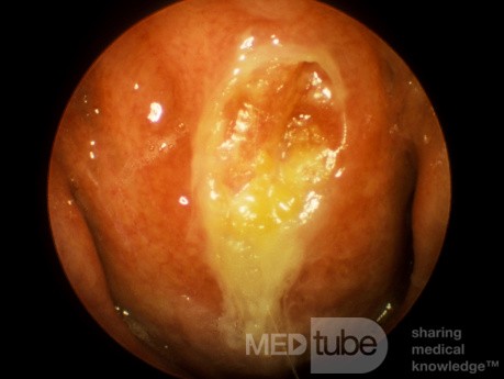 Chronic Nasopharyngitis