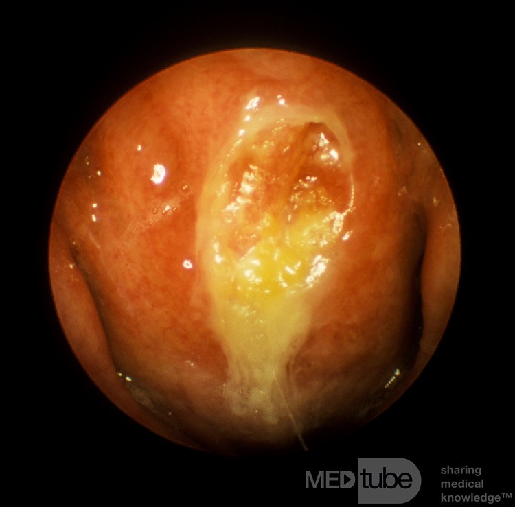 Chronic Nasopharyngitis