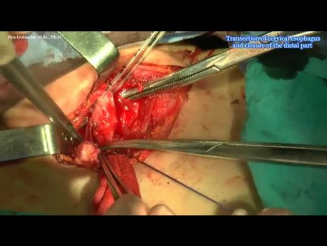 Retrosternal Colon Transposition For Esophageal Burning Stricture 