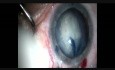Role of Oval Rhexis in Subluxated Cataract