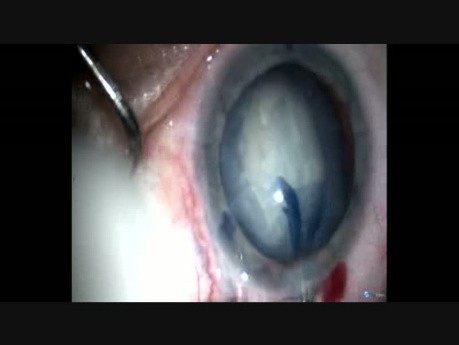 Role of Oval Rhexis in Subluxated Cataract