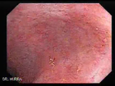 Post-Radiation Colitis (13 of 13)
