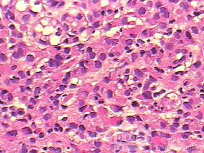 Small Gastric Adenocarcinoma of the Diffuse Ring Cell (5 of 19)