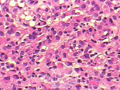 Small Gastric Adenocarcinoma of the Diffuse Ring Cell (5 of 19)