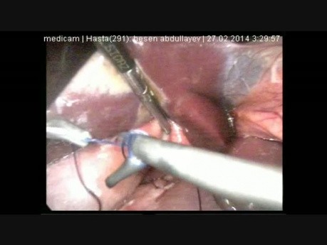 Laparoscopic Repair for Perforated Peptic Ulcer