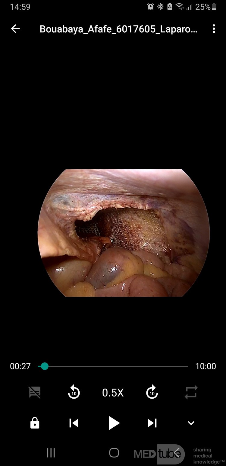 Mesh Placement in a TAPP Surgery