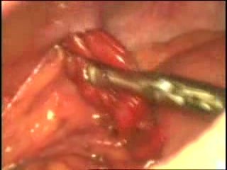Injury Abdomen With Prolapse Of The Omentum And Intestinal Perforation