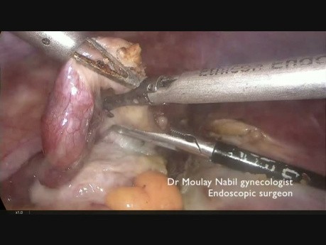 Hysterectomy. Huge 900 Grammes Uterus. Virgin patient.