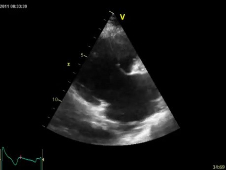Free Tricuspid Insufficiency