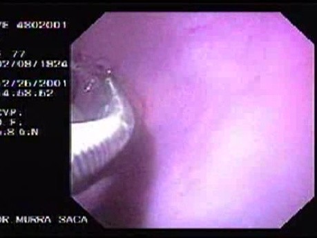 Hemorrhage Due Status Post Rubber Band Ligation of Esophageal Varices - Sclerotherapy 