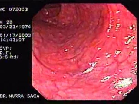 Familial Adenomatous Polyposis of the Colon (21 of 29)