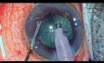 Cataract Surgery in an eye with Pseudoexfoliation and Primary Angle Closure