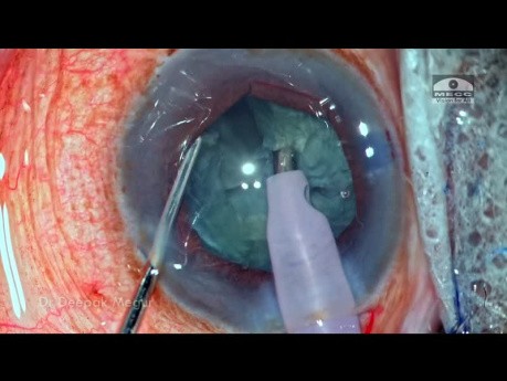 Cataract Surgery in an eye with Pseudoexfoliation and Primary Angle Closure
