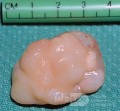 Choanal Polyp Arising From Posterior Septum [surgical specimen]