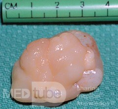 Choanal Polyp Arising From Posterior Septum [surgical specimen]