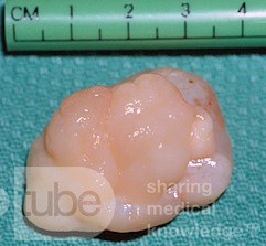 Choanal Polyp Arising From Posterior Septum [surgical specimen]