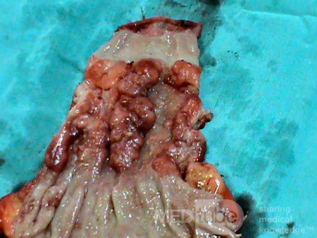 Barrett Adenocarcinoma - Endoscopic Image (18 of 20)