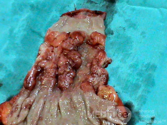 Barrett Adenocarcinoma - Endoscopic Image (18 of 20)