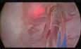 Greenlight Enucleation of the Prostate. GreenLEP