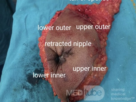 Case of Mastectomy in a 58 Years Old Female with Breast Carcinoma