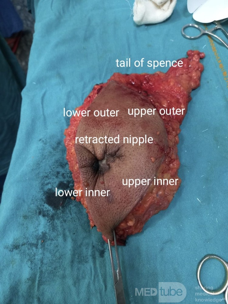 Case of Mastectomy in a 58 Years Old Female with Breast Carcinoma