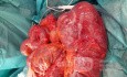 Subtotal Colectomy due to Rectosigmoid Obstruction