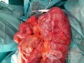 Subtotal Colectomy due to Rectosigmoid Obstruction