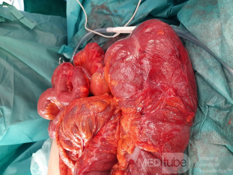 Subtotal Colectomy due to Rectosigmoid Obstruction