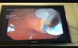 Liver Hydatid Cyst Profection to CBD and Cholangitis and Extraction of Doughter Cyst with ERCP 