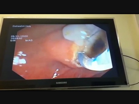 Liver Hydatid Cyst Profection to CBD and Cholangitis and Extraction of Doughter Cyst with ERCP 